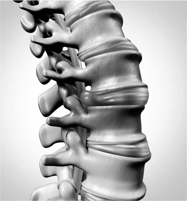 Disc herniation