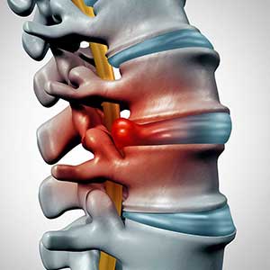 Disc Herniation