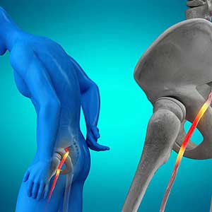 Radiculopathy/Sciatica