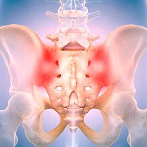 Sacroiliitis