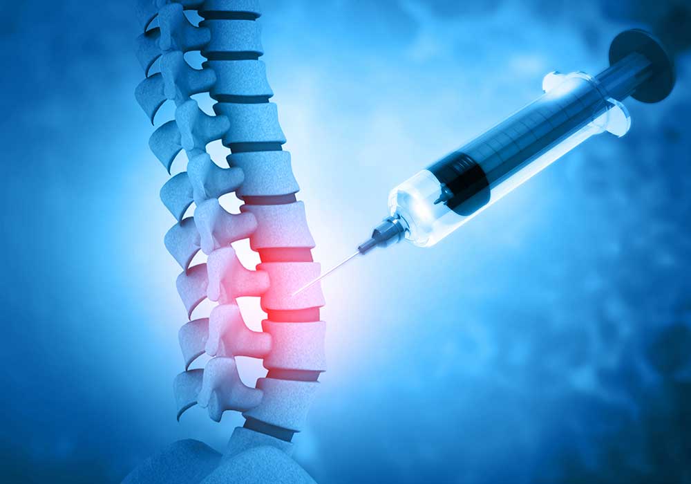 Epidural Corticosteroid Injection