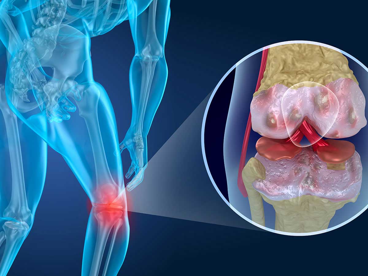 Knee Pain Conditions