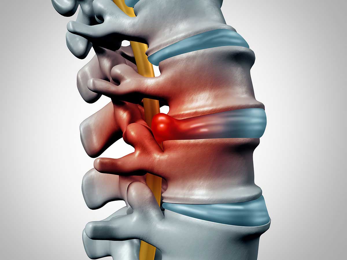 Disc Herniation