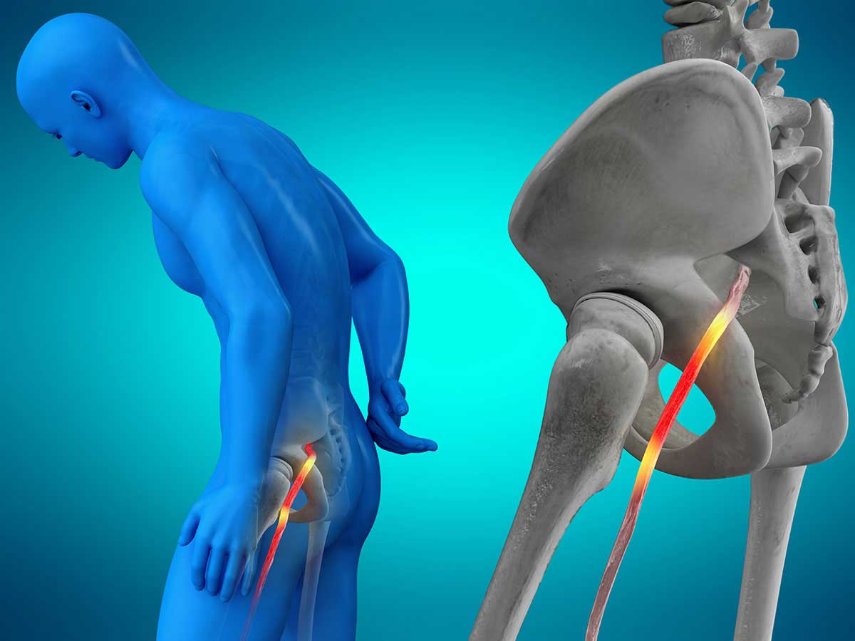 Radiculopathy / Sciatica